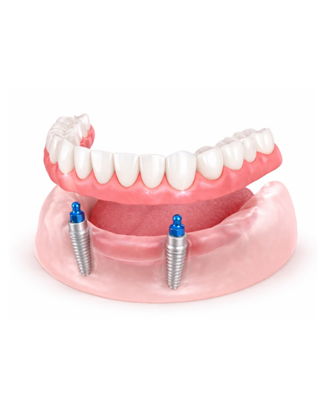 Implant-Retained Dentures