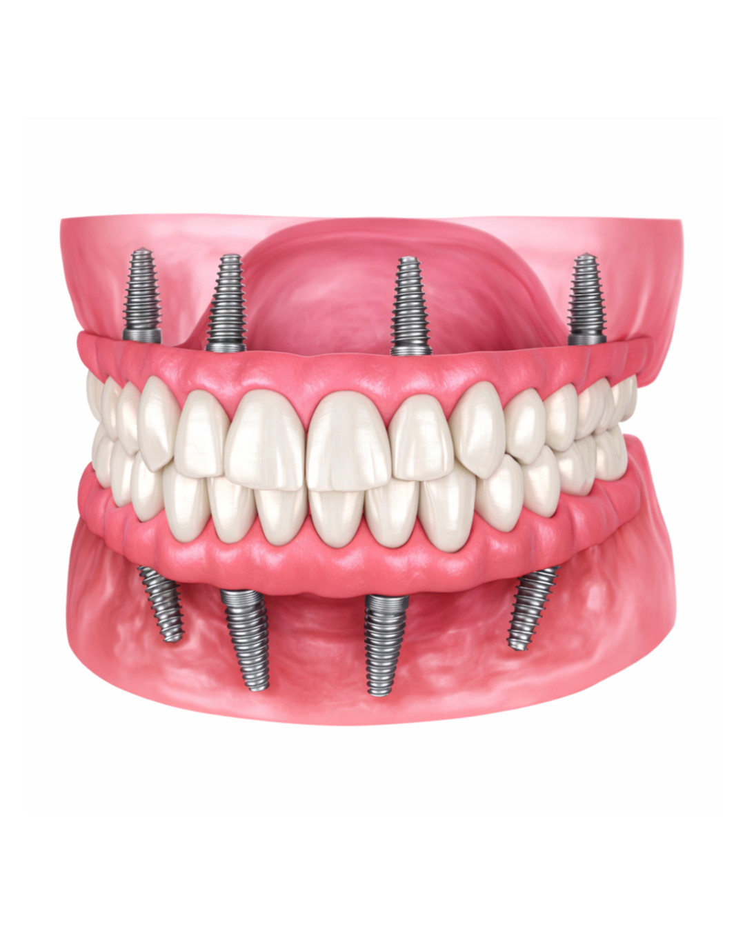 Full Fixed Dentures
