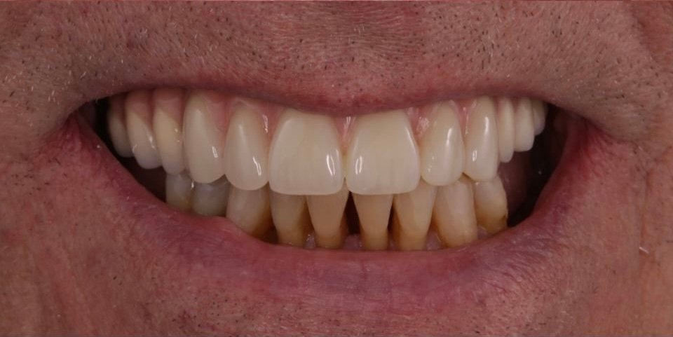 Jake after dental implants