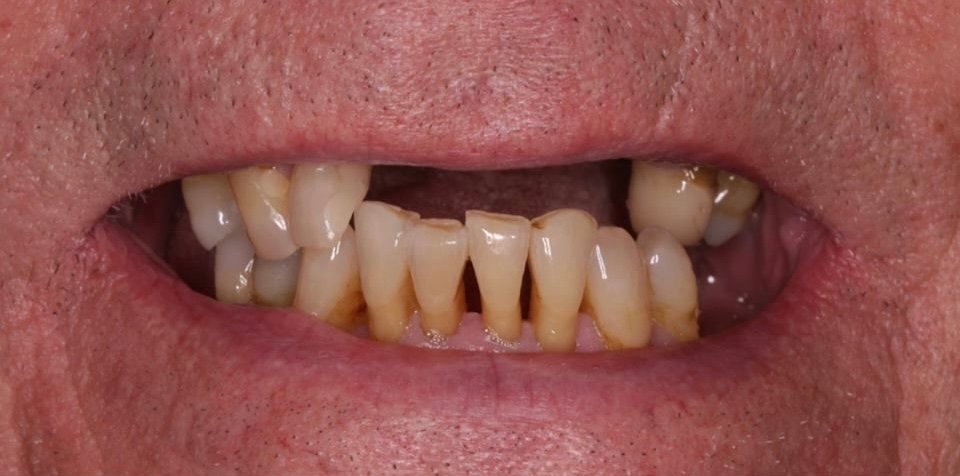 Jake before dental implants