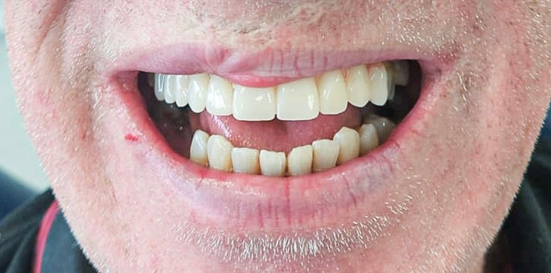 Robert after dental implants