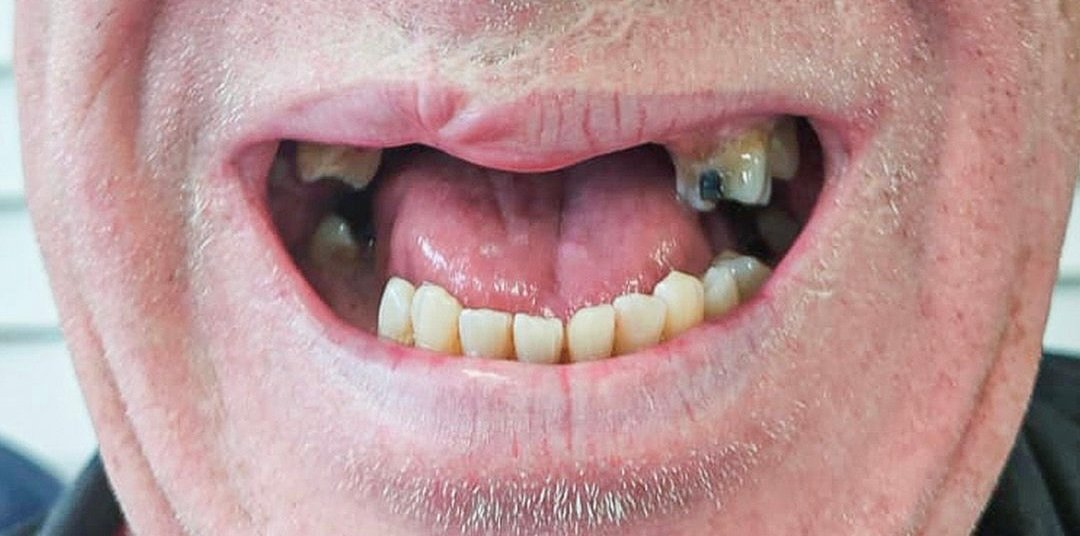 Robert before dental implants