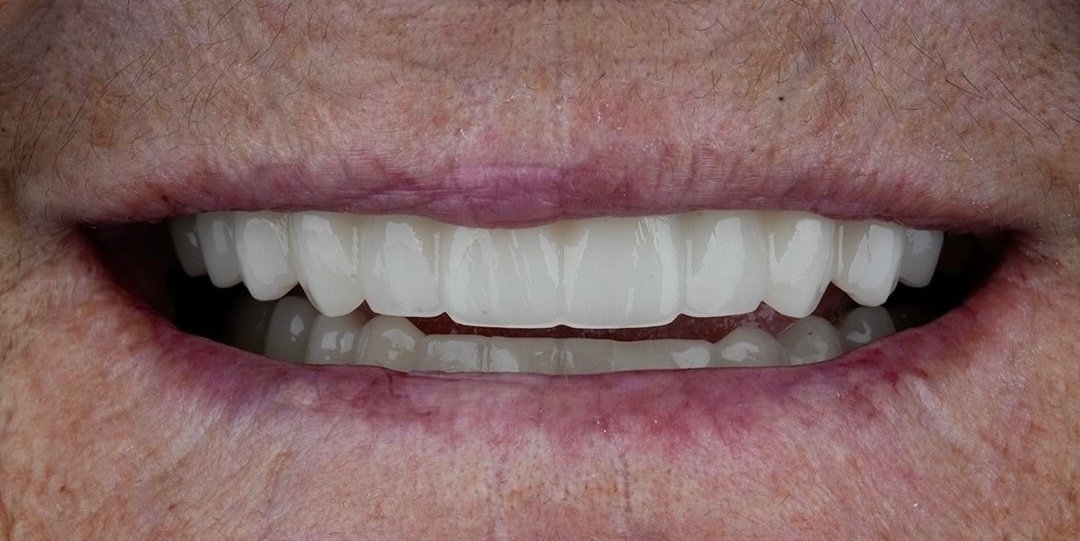 Linda after dental implants