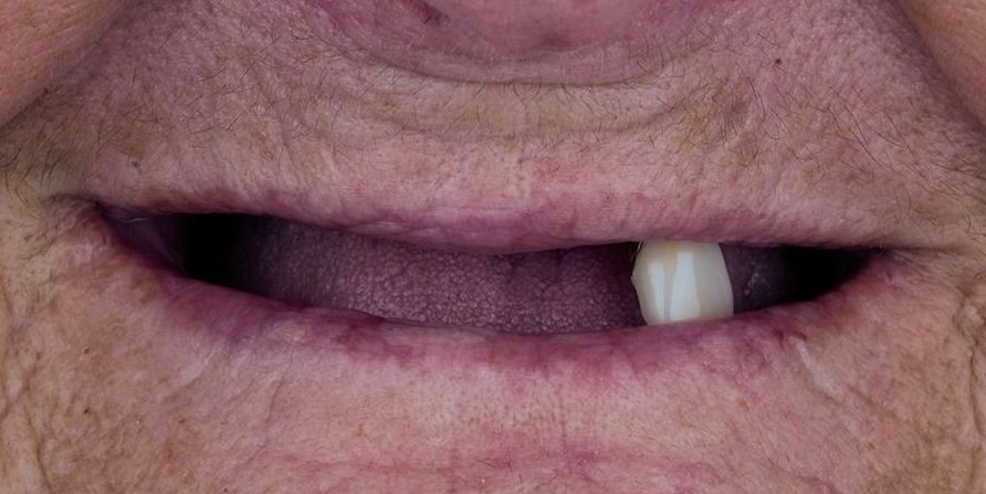 Linda before dental implants