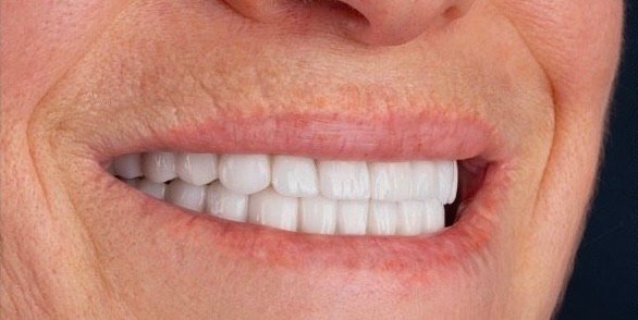 Margaret after dental implants
