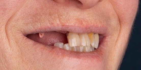 Margaret before dental implants